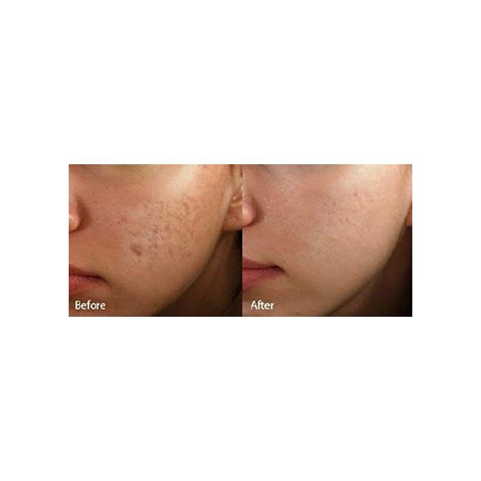 keeva acne scar cream