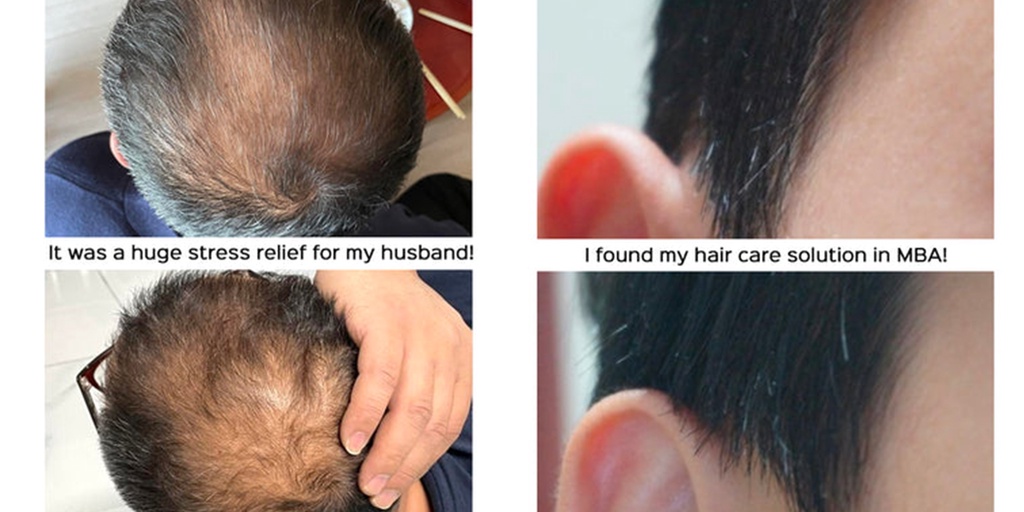 MBA) Upgraded % Derma Scalp Black Turn Hair Shampoo 500ml - COCOMO |  Shopee Singapore
