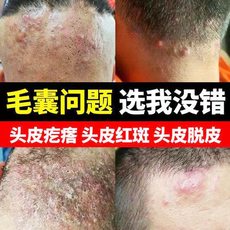 Spot goods/ointment□℗℗Specializing in the treatment of scalp folliculitis,  pimples on the back of the head, acne, acne, | Shopee Singapore