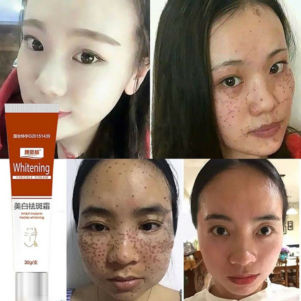 melasma removal