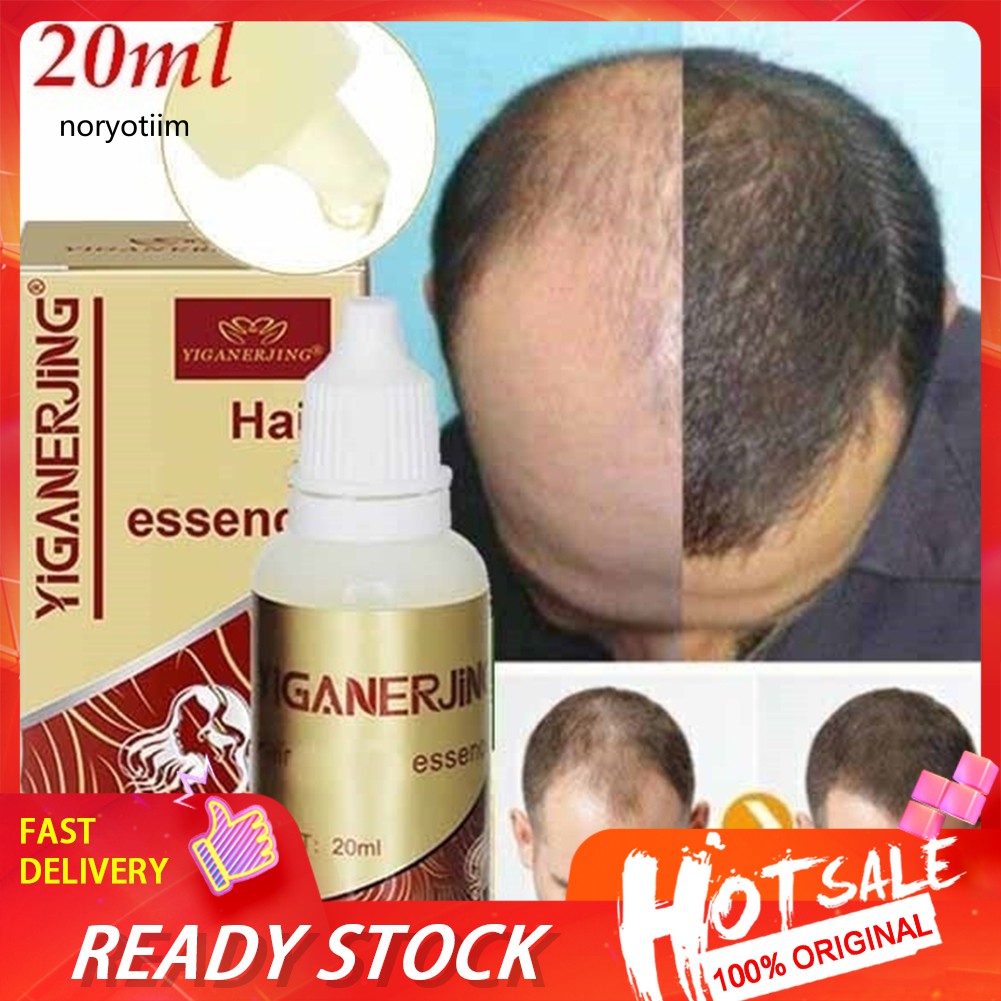 ✽WMF✽Unisex Hair Growth Essence Anti Loss Scalp Treatment Oil Control  Health Care | Shopee Singapore