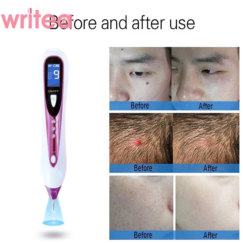 laser freckle removal