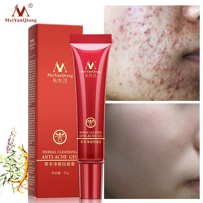 Meiyanqiong Krim Herbal Untuk Menghilangkan Jerawat Bekas Luka Bekas Jerawat Perawatan Wajah Shopee Singapore