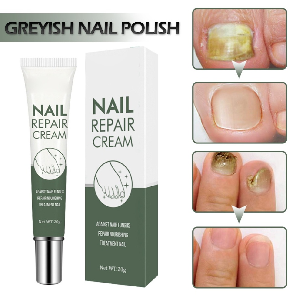 20g Nail Repair Cream Restores Discolored Damaged Nails for Toenail Care |  Shopee Singapore