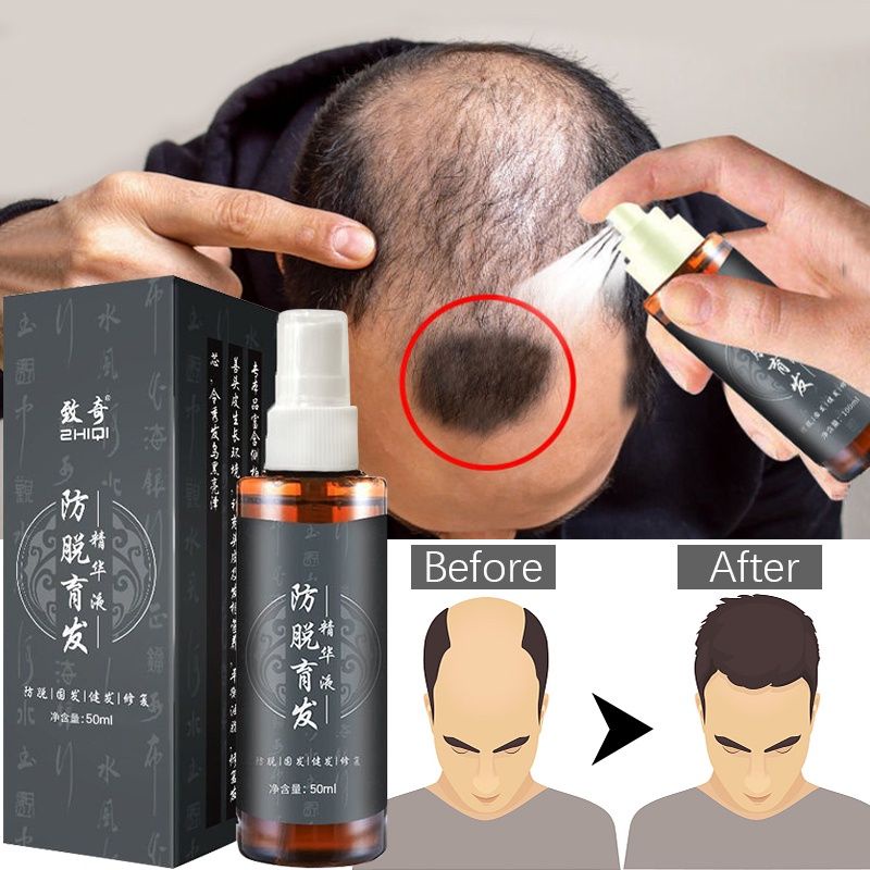 生发液⭐Hair Tonic Fast Hair Growth Serum Spray Anti-Hair loss Serum Oil Anti-Hair  Fall Treatment For Men and Women 100ml | Shopee Singapore