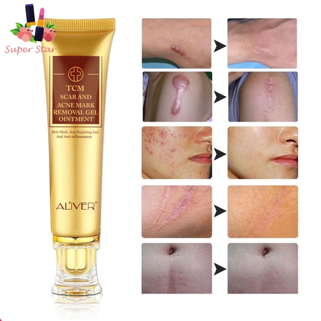 face burned from acne cream