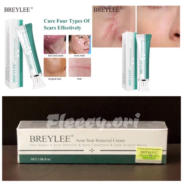 breylee acne scar removal cream