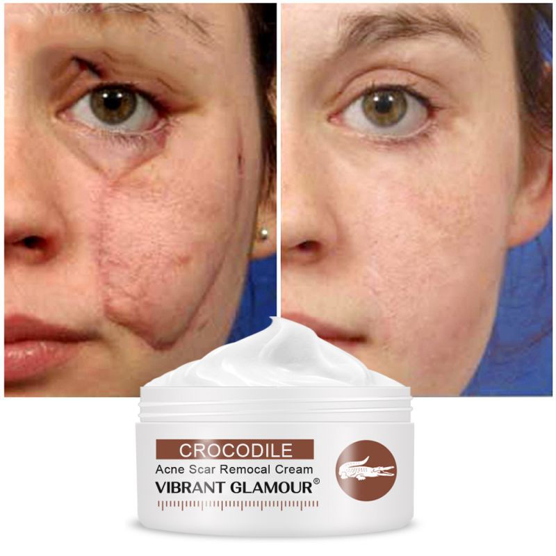 stretch mark healing cream