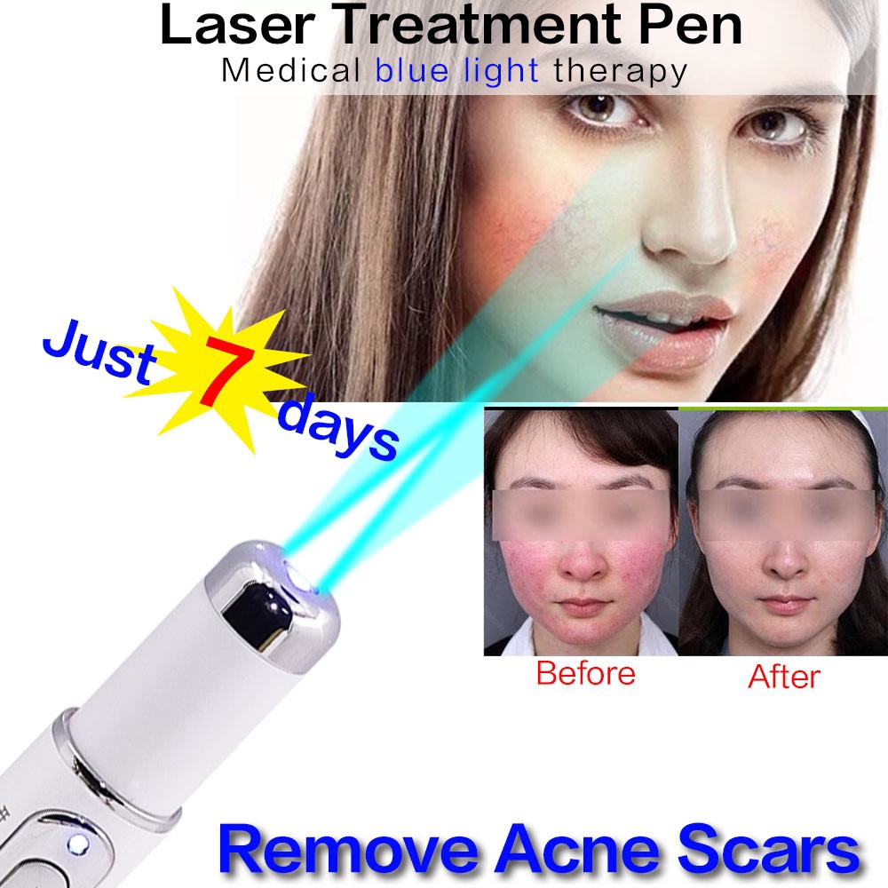 Soft Scar Varicose Veins Treatment Blue Light Therapy Laser Pen Wrinkle Singapore