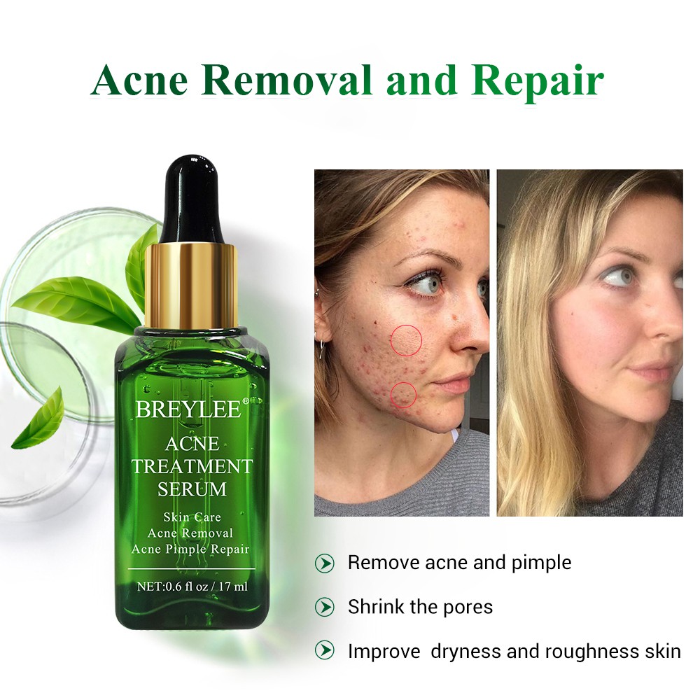 breylee acne treatment serum