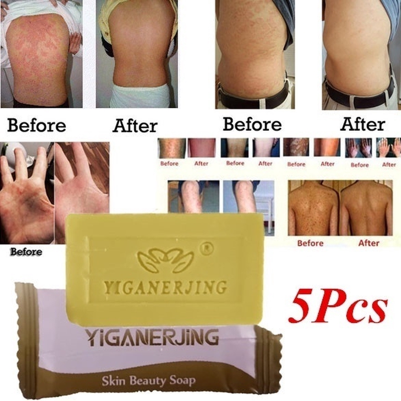 Handmade 5pcs Sulfur Soap Skin Conditions Acne Psoriasis Seborrhea