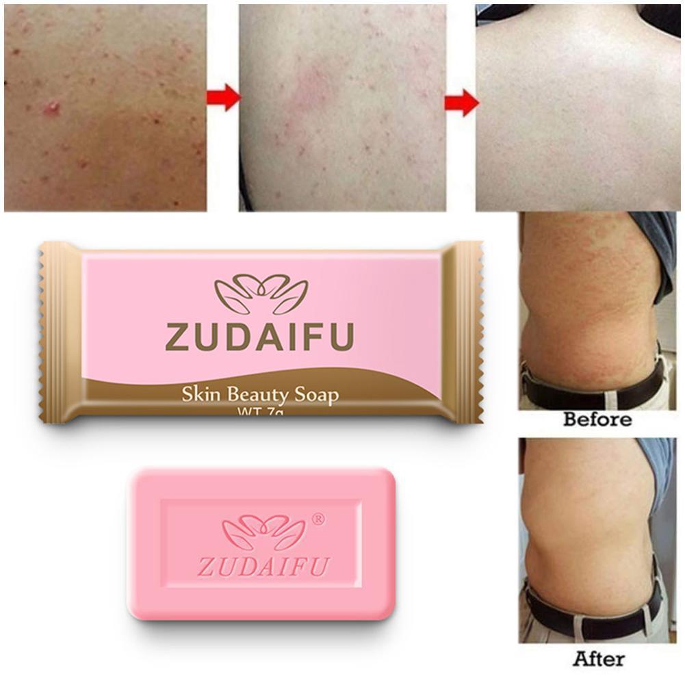 1PC Sulfur Soap Skin Antibacterial Treatment Acne Anti Fungus Oil