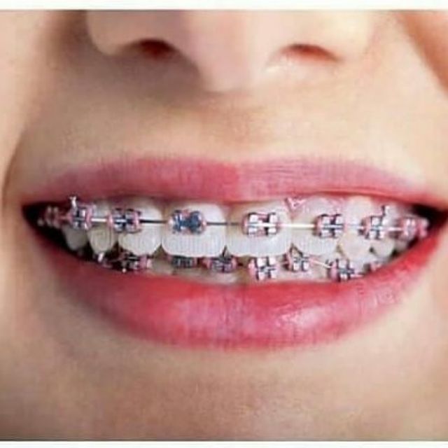 Shop Malaysia Braces Fake Power O Clearance Stok Shopee Singapore