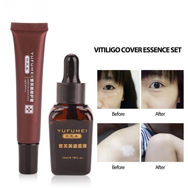 vitiligo concealer