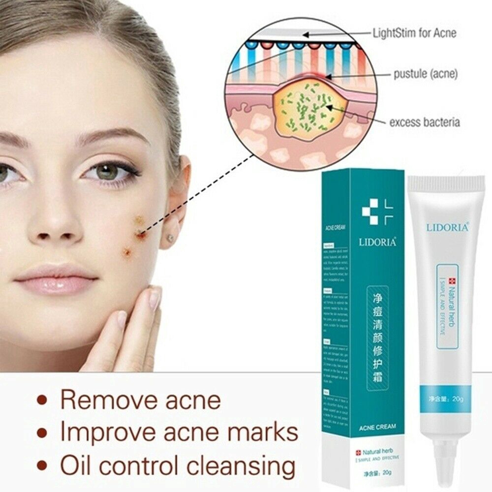 remove acne cream