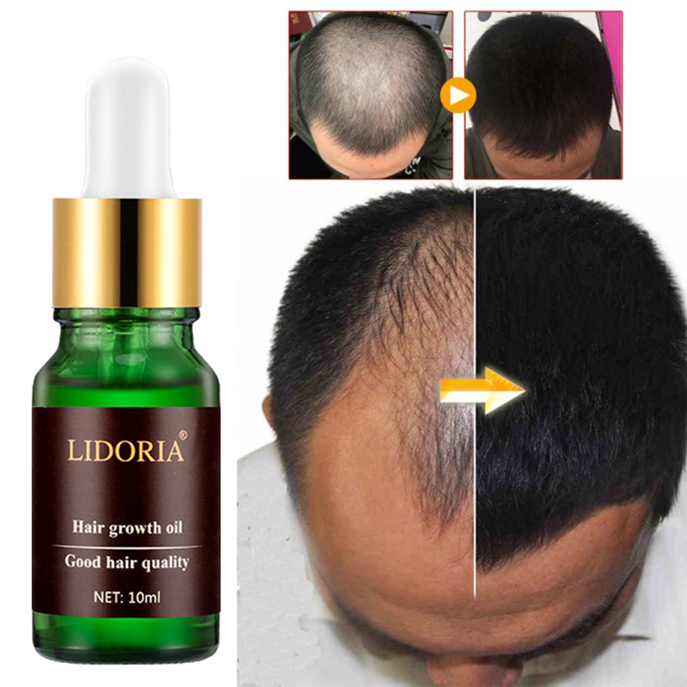 Hair Growth Essential Oils Original Hair Loss Care Treatment | Shopee  Singapore