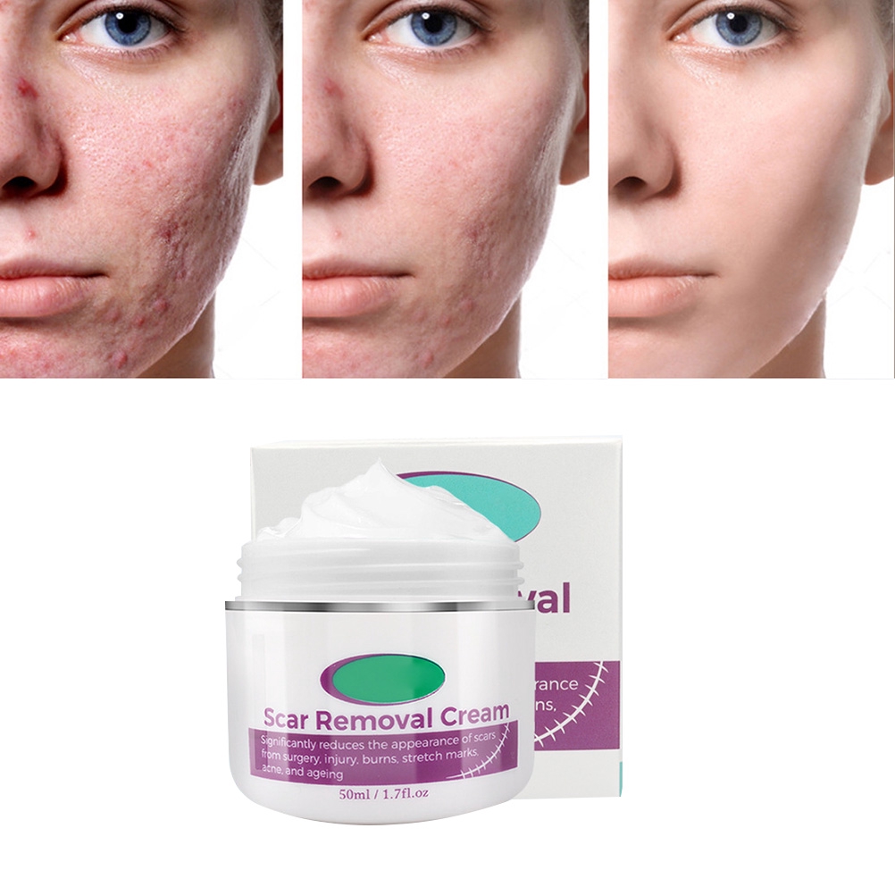 stretch marks removal cream for men