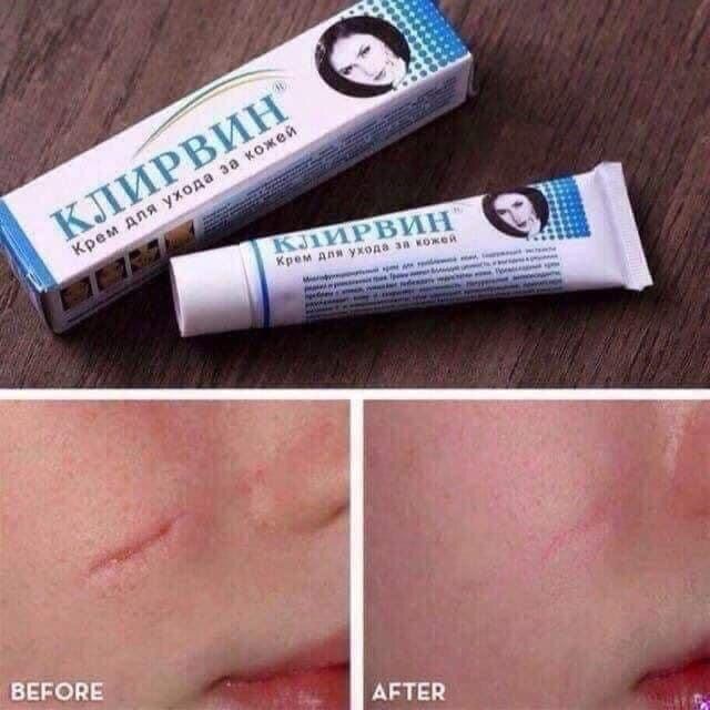 ayurvedic stretch marks removal cream