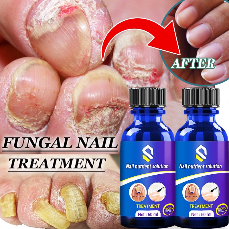 Nail Fungus Treatment Essence Nails Foot Repair Toe Nail Fungal Removal Gel Anti Infection