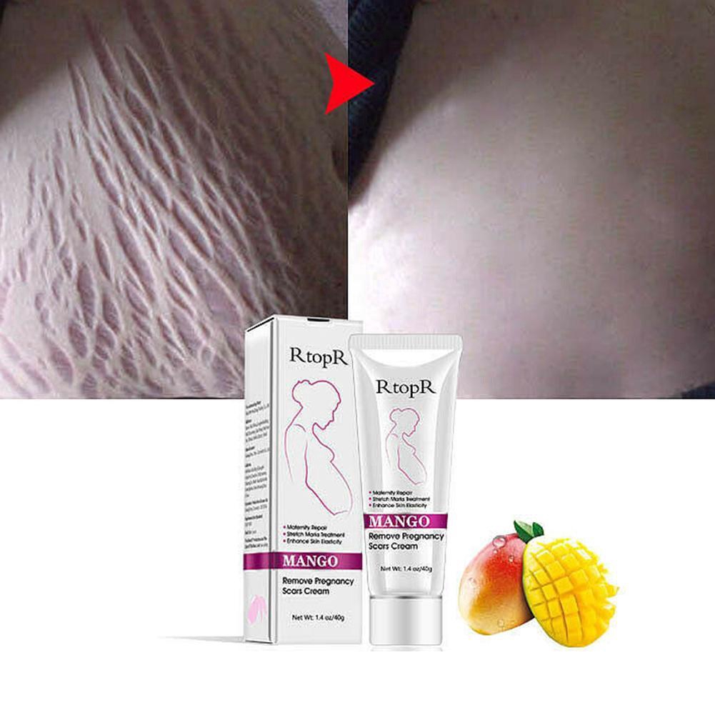 mango stretch mark cream