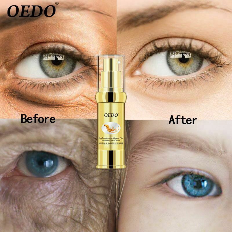 dark circles hyaluronic acid