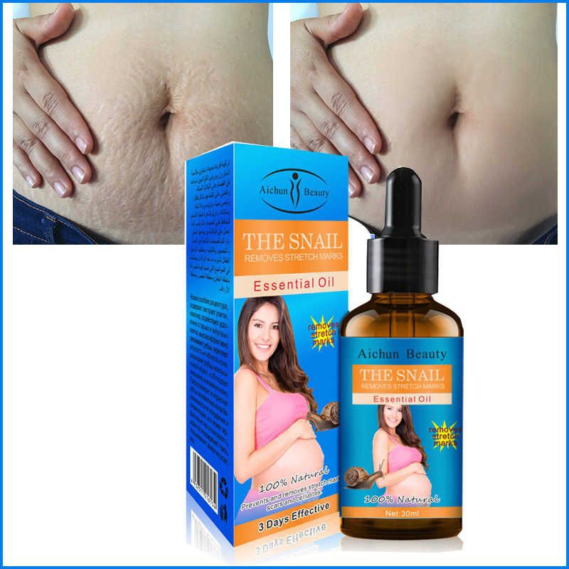 Stretch Mark Removal Hilangkan Stretchmark Bersalin Parut Selulit Gemuk Remove Stretch Marks The Snail Aichun Beauty Shopee Singapore