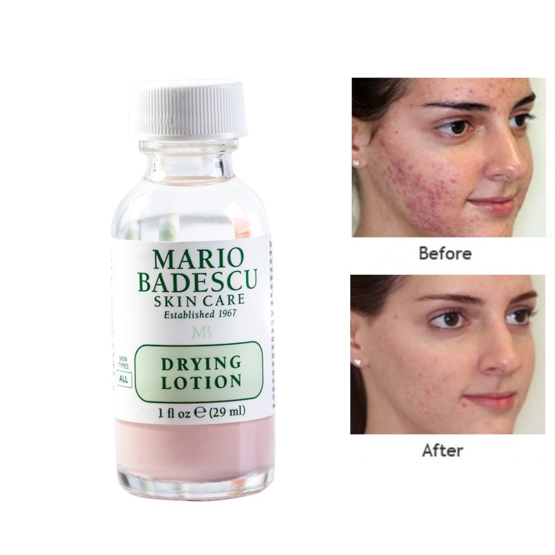 mario badescu acne