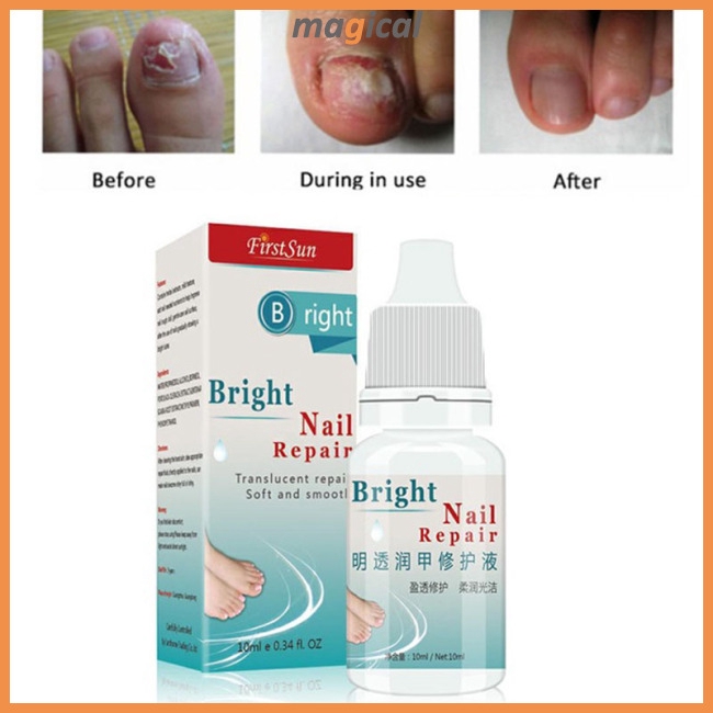 Nail Fungus Treatment Cream Onychomycosis Paronychia Anti Fungal Nail Infection Shopee Singapore