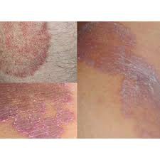 Ubat Itching Skin Crevice Cream 5g Dermaheu Shopee Singapore