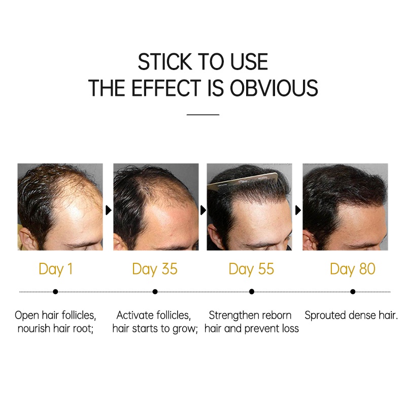 PURC Hair Growth Essence Oil Vitamin B7 Prevent Hair Loss Serum Scalp  Treatments Fast Growing Hair Care 50ml | Shopee Singapore