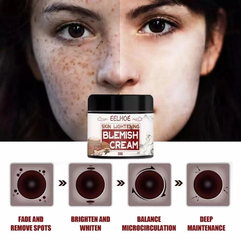 Chloasma and Chloasma Face Cream Whitening Effective Black Spot Remover
