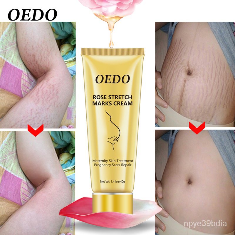 cara menggunakan oedo rose remove stretch mark cream
