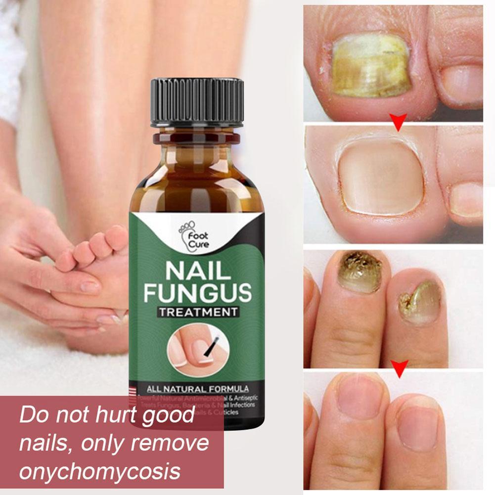 30ml Fungal Nail Repair Essence Serum Care Removal Infection Toenail Anti Fungus  Nail Treatment | Shopee Singapore