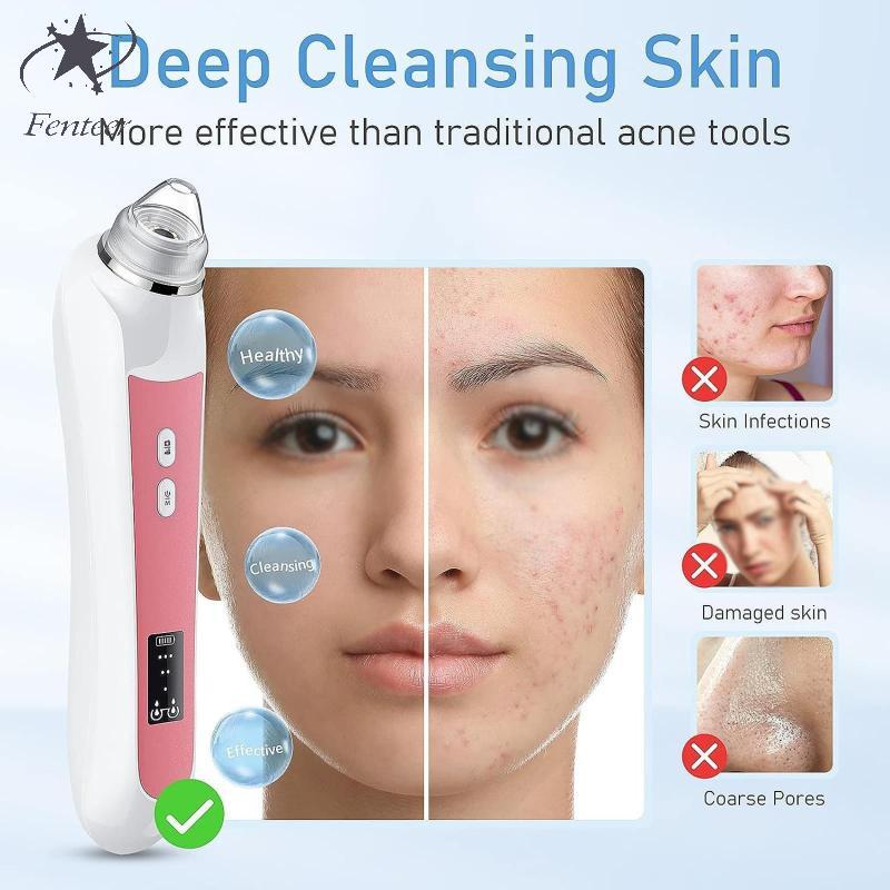 [Fenteer] Blackhead Remover Vacuum Blackhead Extractor Pore Cleaner Black Head Extractions Tool Pore Vacuum