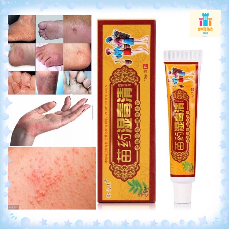 Eczema Psoriasis Beriberi Fungus 100% Chinese Herbal Cream Ubat Gatal ...