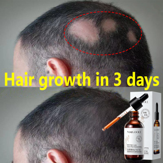 【7 Day Hair Growth】Hair Growth Serum Anti Hair Loss Promotes Thicker Stronger Hair And Hair Regrowth for Men Women Hair Tonic For Hair Loss