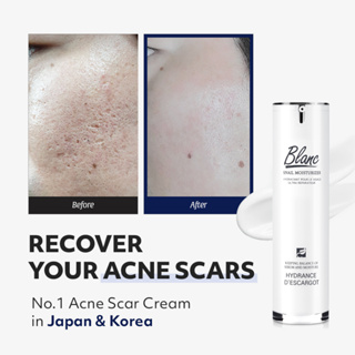 [ Blanc Nature Official ] Acne & Acne Scar Treatment Cream   No.1 in Removing Acne Scar in Korea and Japan